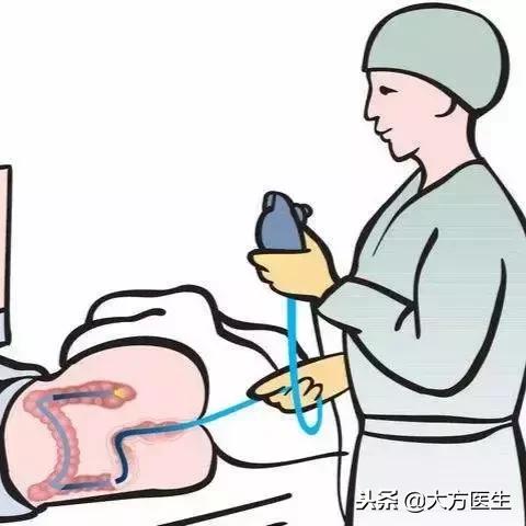 肠镜新技术，消化道检查新篇章开启