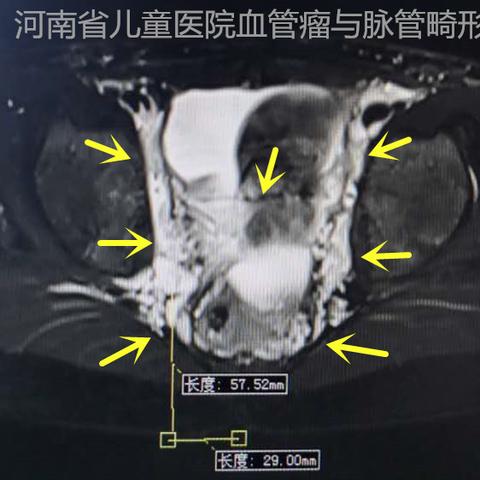 淋巴管畸形治疗最新进展研究