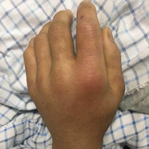 休克最新补液治疗策略详解