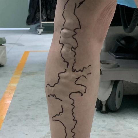 最新血栓治疗技术，重塑生命健康之路